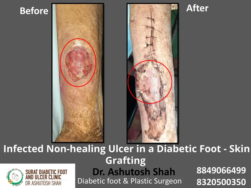 Diabetic Foot  PPT 3 checked by sir.pptx-6.webp